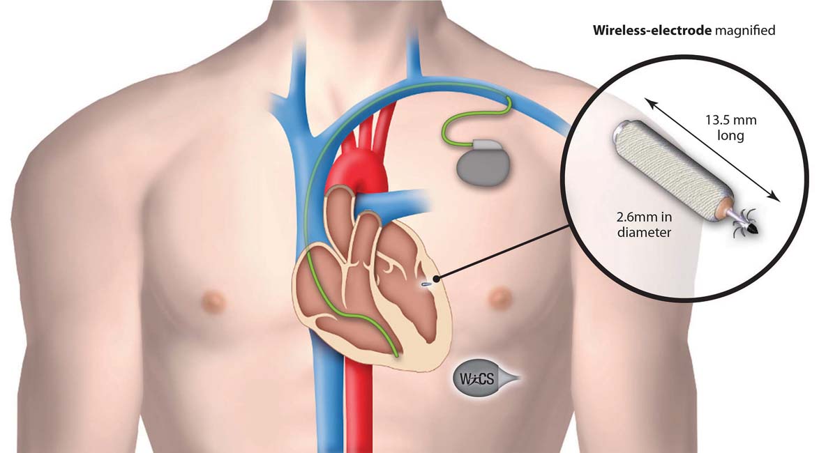 bluetooth-enabled-pacemakers